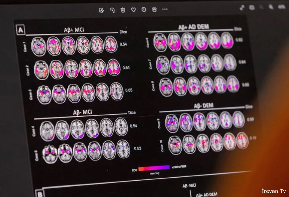 Alzheimer xəstəliyinin müalicə üsulları dəyişə bilər